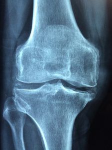 radiografía-de-artritis