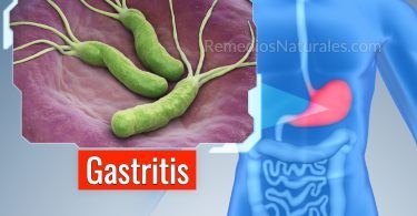 remedios naturales para la gastritis