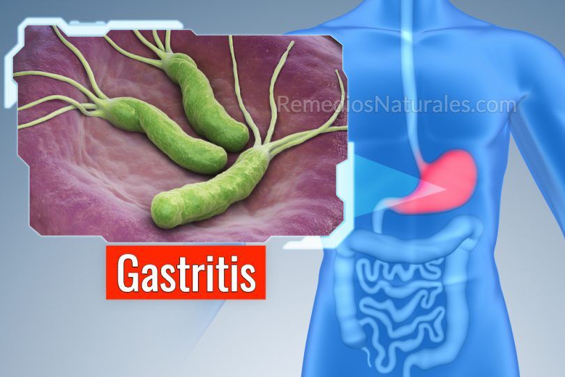 remedios naturales para la gastritis